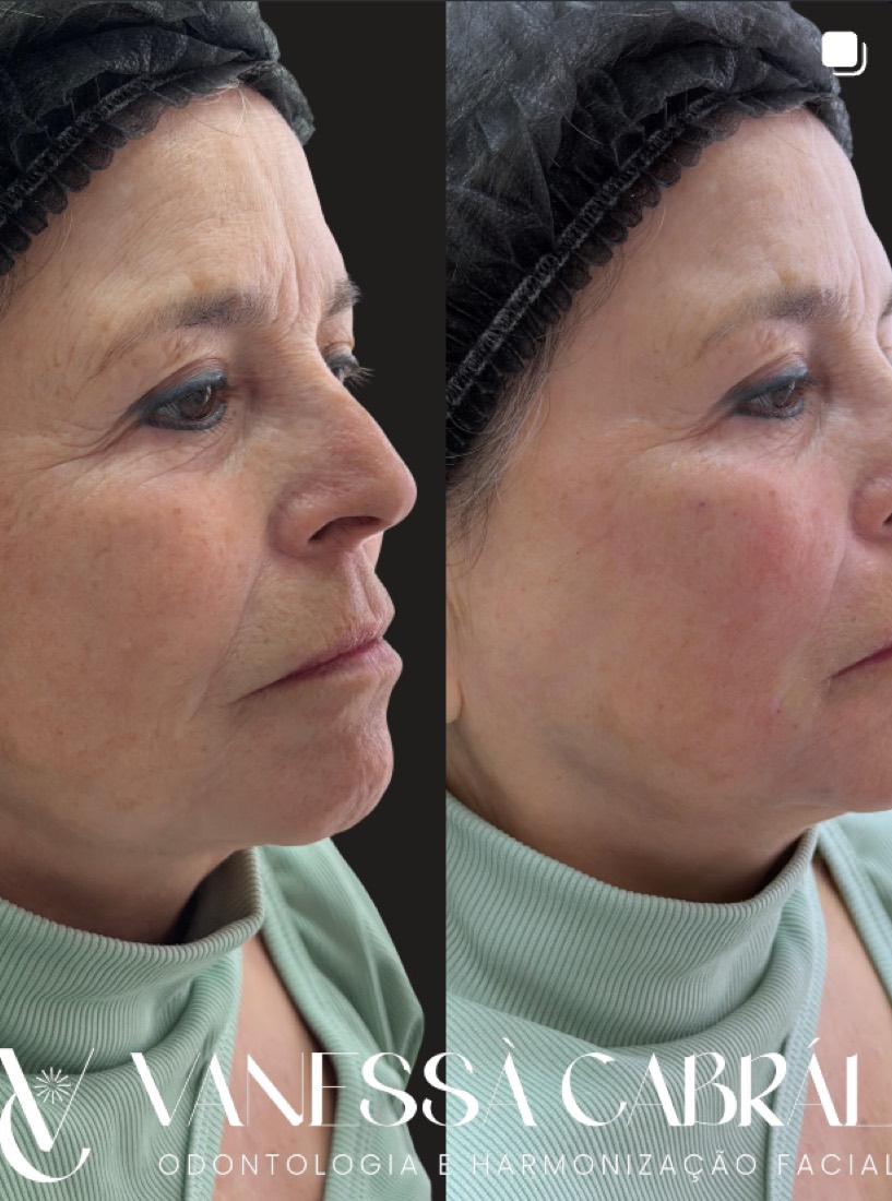Antes e depois de harmonização facial, melhora de flacidez