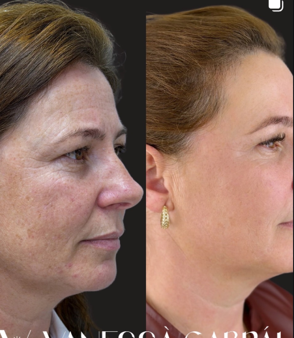 Antes e depois de harmonização facial, pele revitalizada